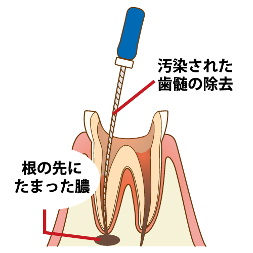 歯の神経を残せるかどうか