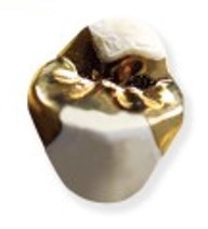 ゴールドインレー